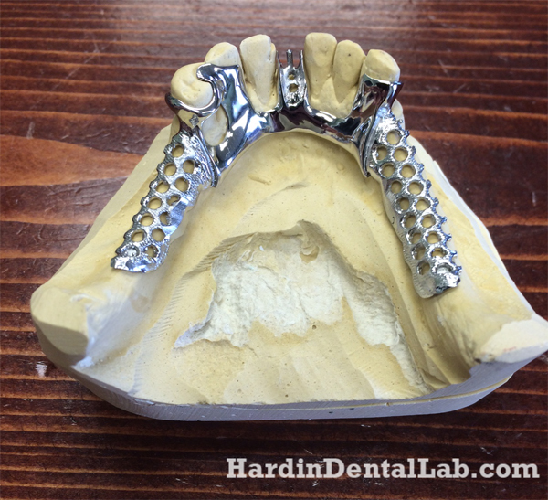 Mandibular Cast Partial Framework